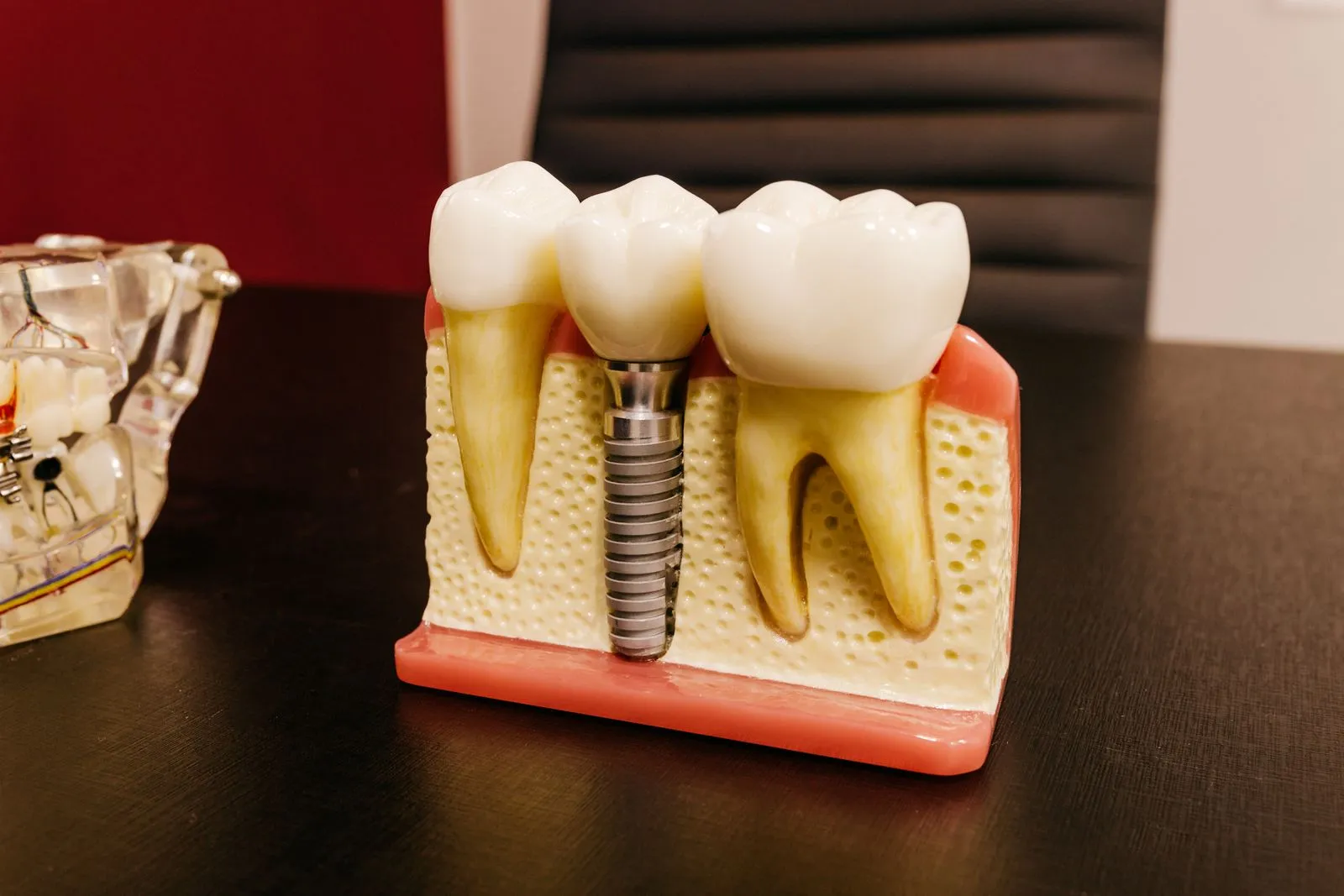 Modelo de implante dental en la Clínica Dental Sixto Rivas